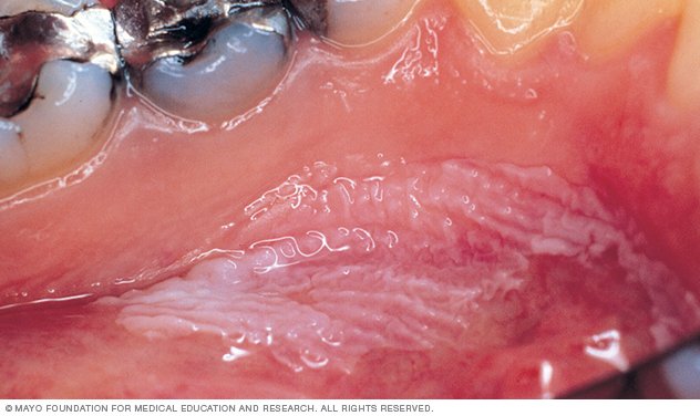 Mouth Cancer Disease Reference Guide